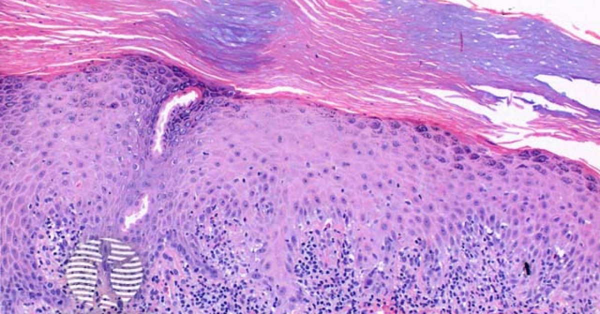 Porokeratosis pathology image