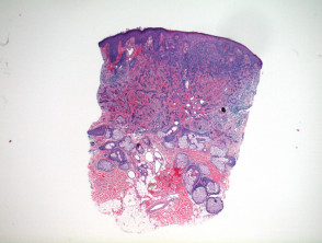 Desmoplastic trichoepithelioma pathology