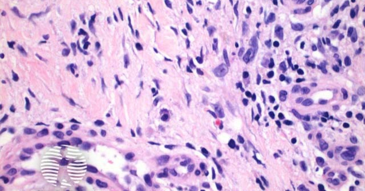 Necrobiosis lipoidica pathology image