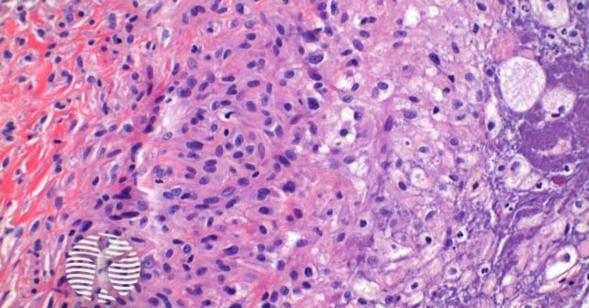 DermNet® - Phaeohyphomycosis pathology image