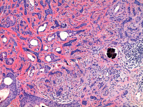 Desmoplastic trichoepithelioma pathology