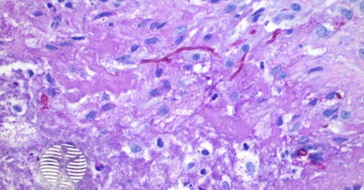 Phaeohyphomycosis pathology, PAS stain image