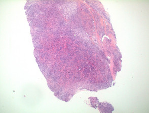 Giant cell tumour of tendon sheath  pathology