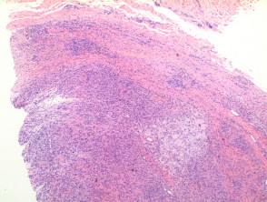 Giant cell tumour of tendon sheath  pathology