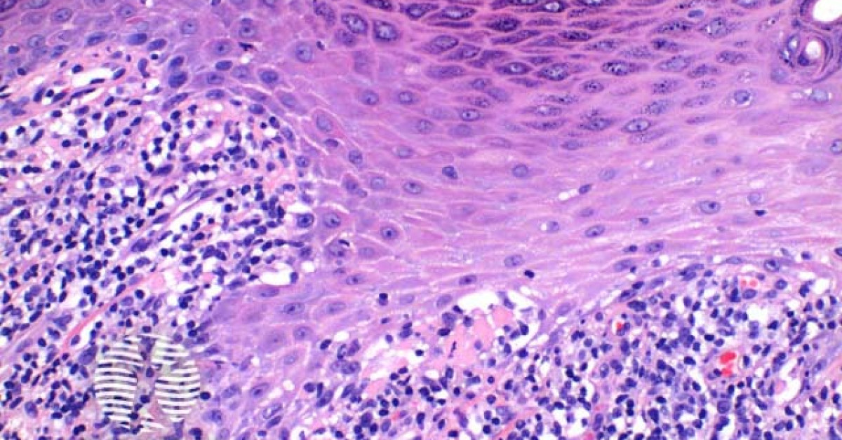 Lichen planus pathology image