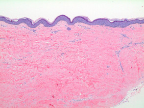 Lichen sclerosus  pathology
