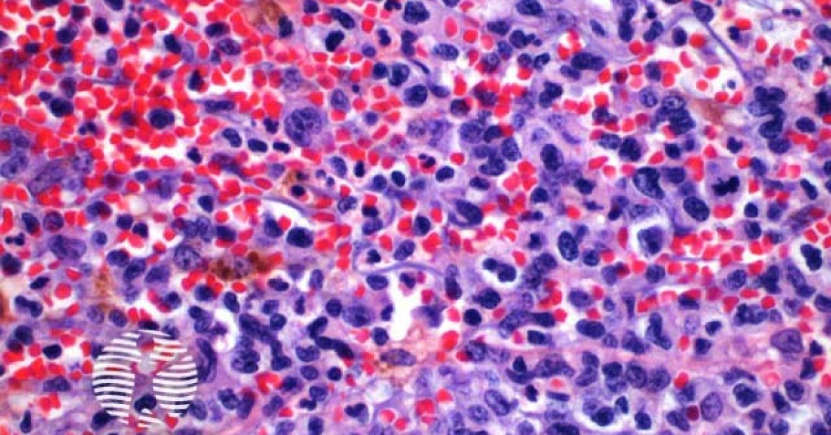 Dermnet® Lymphomatoid Papulosis Pathology Image