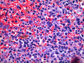 Lymphomatoid papulosis  pathology