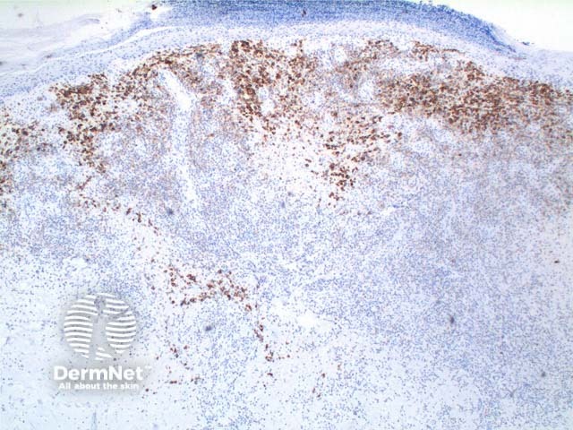 Immunohistochemistry: CD30 positive atypical T-cells in lymphomatoid papulosis