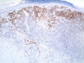 Lymphomatoid papulosis pathology CD30+ stain