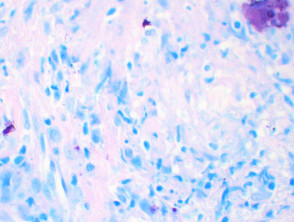 Mycobacterium marinum skin infection pathology; Ziehl-Neelsen stain
