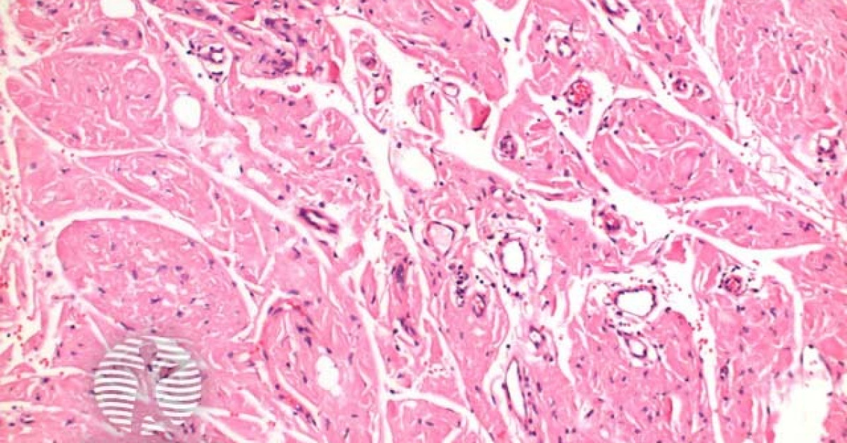 Primary Cutaneous Amyloidosis Pathology Image 4254