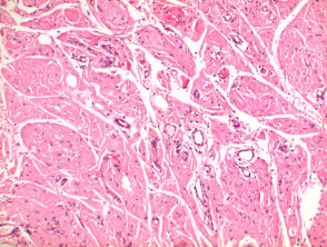 Primary cutaneous amyloidosis pathology