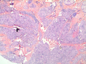 Sarcoidosis  pathology