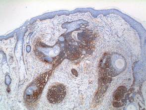Trichoepithelioma pathology, BCL-2 stain