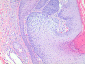 Trichilemmoma pathology