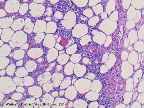 Aspergillosis pathology