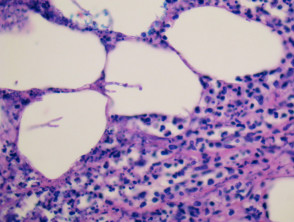 Aspergillosis pathology