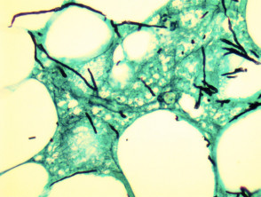 Aspergillosis pathology GMS stain