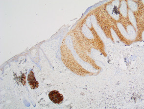EMA+ in clear cell acanthoma