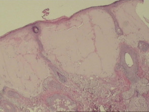 Colloid milium pathology