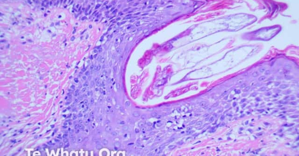 DermNet® - Demodicosis Pathology Image