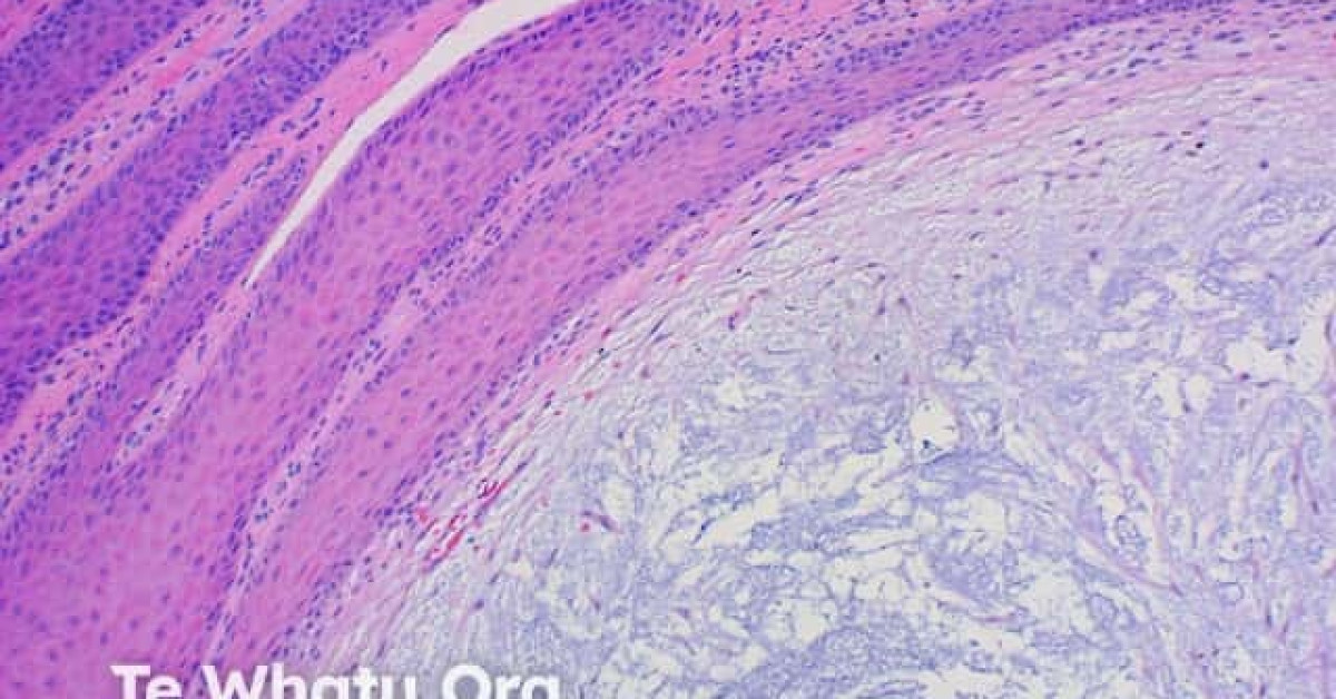 DermNet® - Digital myxoid pseudocyst pathology image