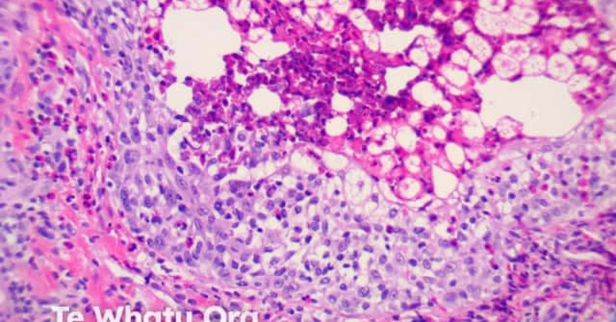 DermNet® - Eosinophilic Pustular Folliculitis Pathology Image