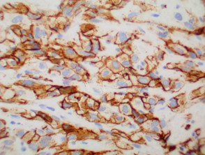 CD31 positive in epithelioid angiosarcoma