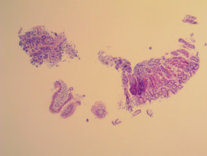 Gastric carcinoid pathology