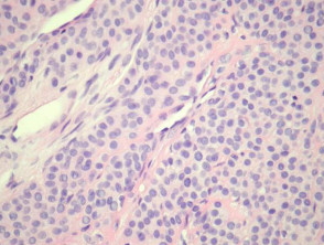 Glomus tumour pathology