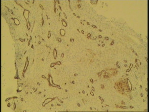 Glomus tumour pathology CD31 stain