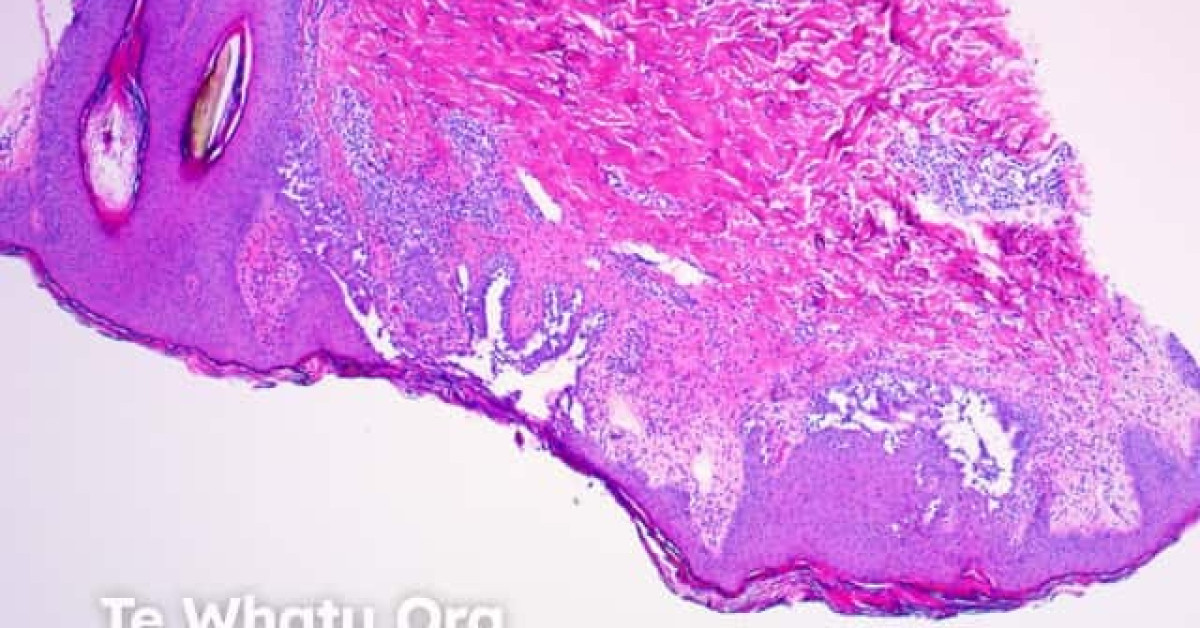 Hailey Hailey disease pathology image