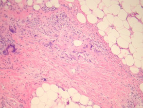 Necrobiotic xanthogranuloma pathology