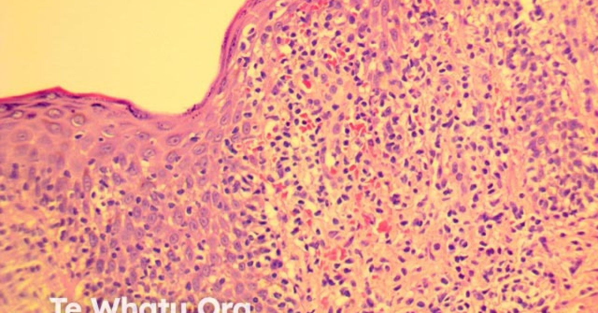 Pityriasis lichenoides et varioliformis acuta (PLEVA) pathology image