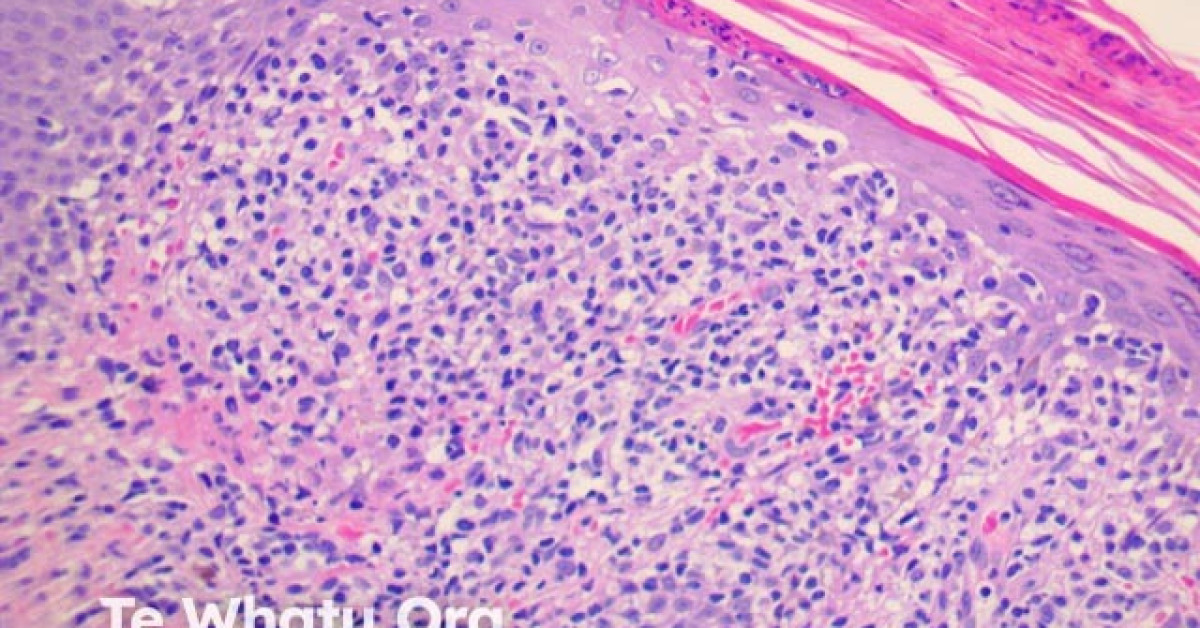 Pityriasis lichenoides et varioliformis acuta (PLEVA) pathology image