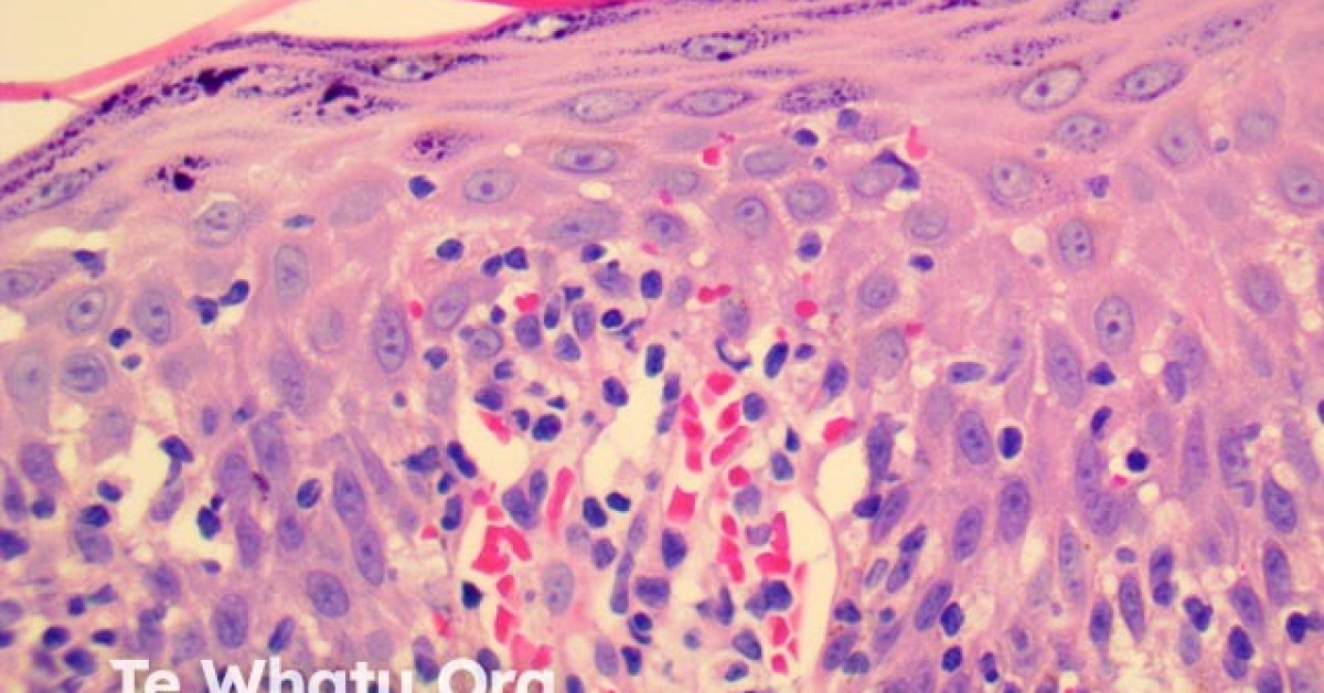 Pityriasis lichenoides et varioliformis acuta (PLEVA) pathology image