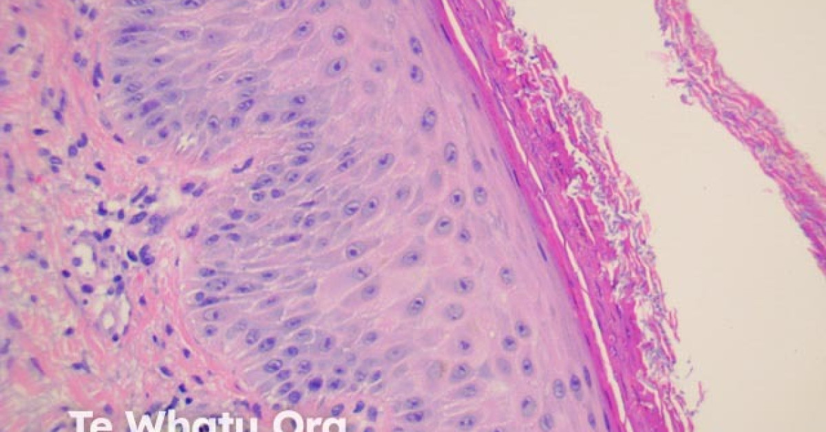 Tinea incognito pathology image