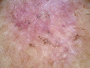 Perpendicular white lines, blue globule, leaf-like structures in pigmented basal cell carcinoma dermoscopy