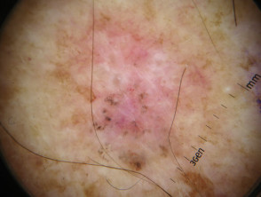 Pigmented basal cell carcinoma dermoscopy