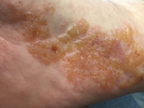 what is dyshidrotic eczema and how do you know if you have it skin bumps eczema remedies eczema