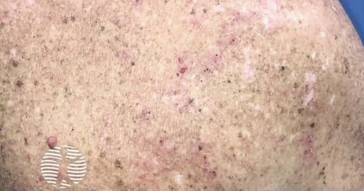 Eczema induced by pembrolizumab image