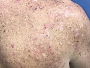 Eczema induced by pembrolizumab