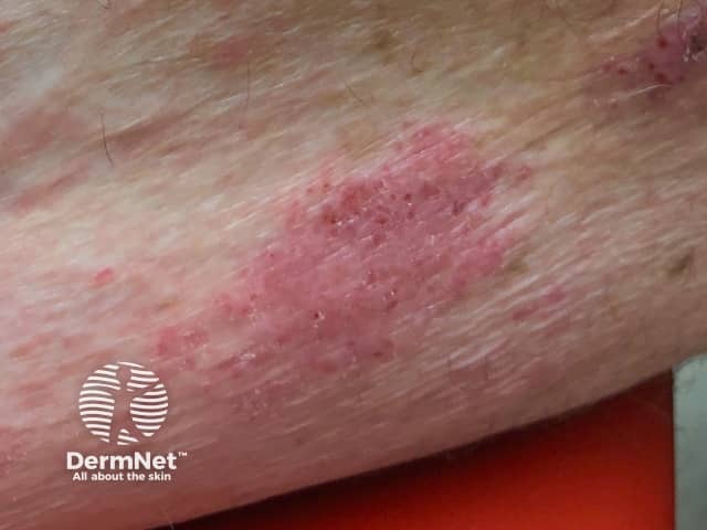 Eczema induced by pembrolizumab