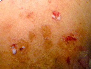 sores on body from drugs