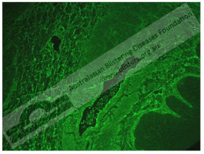 Pemphigus foliaceus indirect immunofluorescence