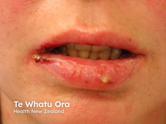 Oral pemphigus