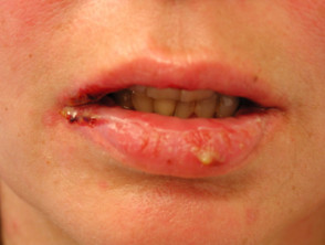 Pemphigus affecting lips