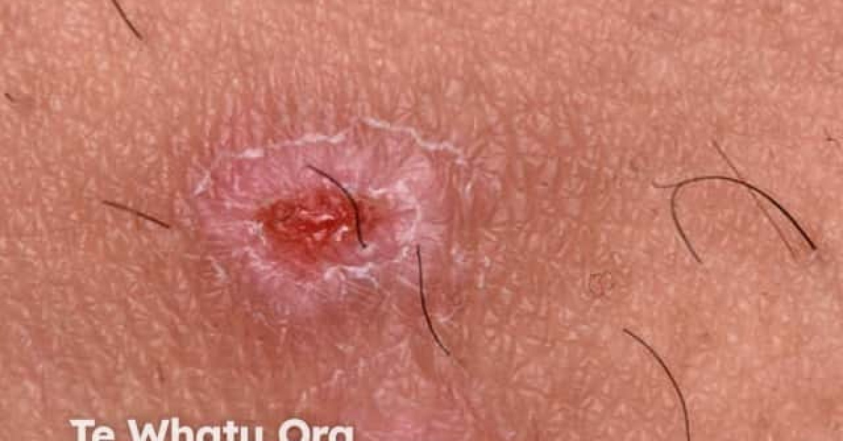 Pemphigus vulgaris image