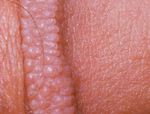 Penis on rim of small bumps Small Pimple